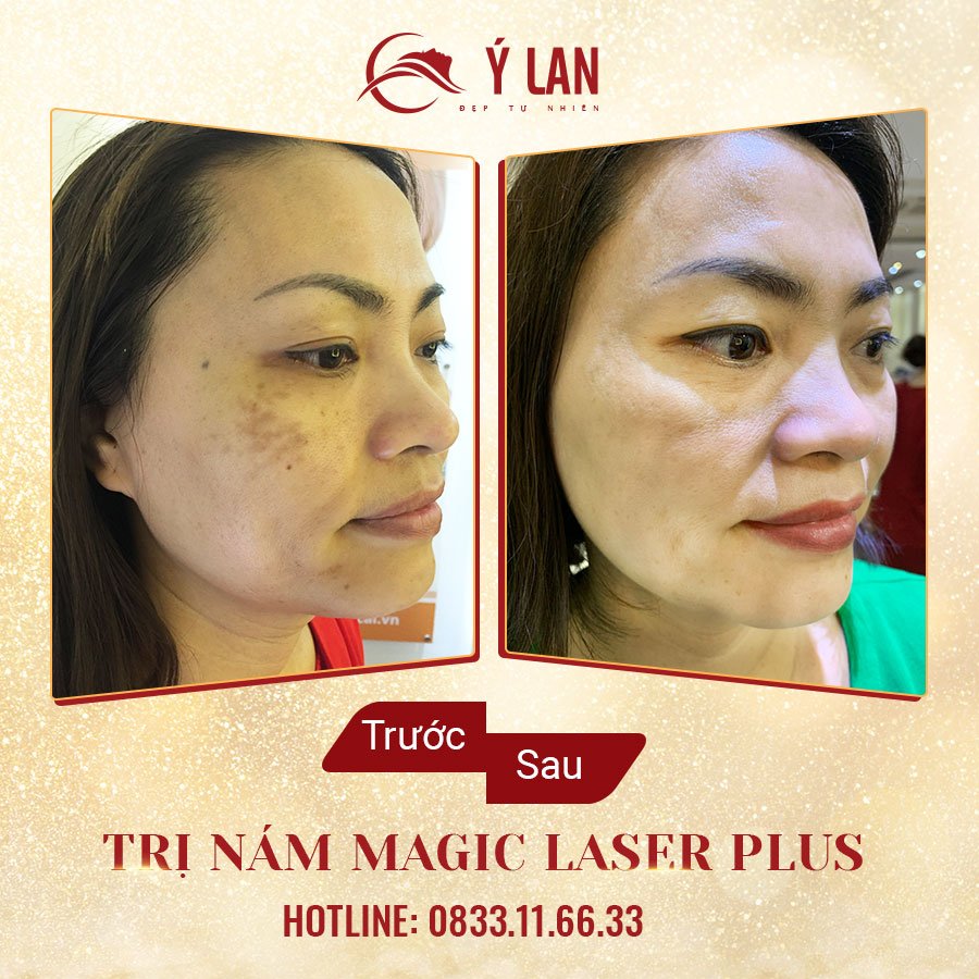 giam-50%-dv-tri-nam1