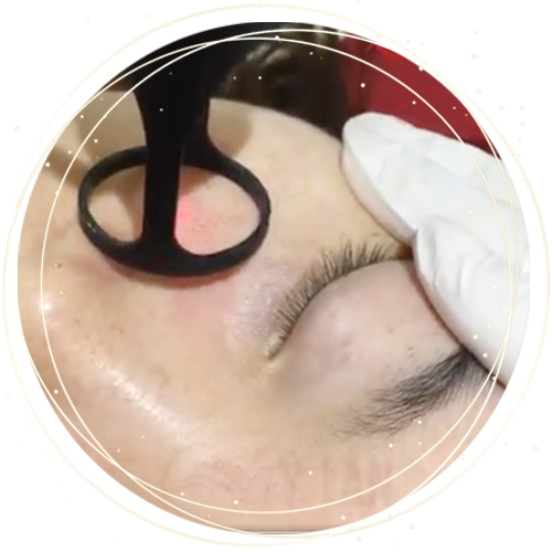 Thu-nhỏ-lỗ-chân-lông-CO2-Fractional