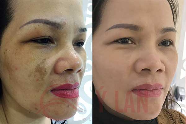 cach-tri-nam-da-mat-lau-nam