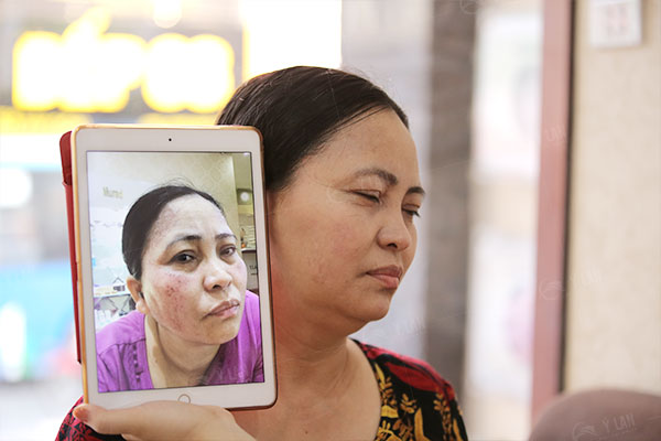 bi-quyet-tri-nam-tan-goc-nhieu-nguoi-da-thanh-cong-1