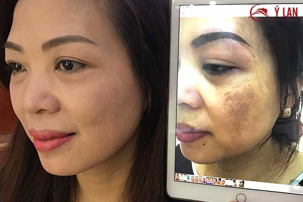 trị nám tàn nhang lâu năm với Magic laser plus