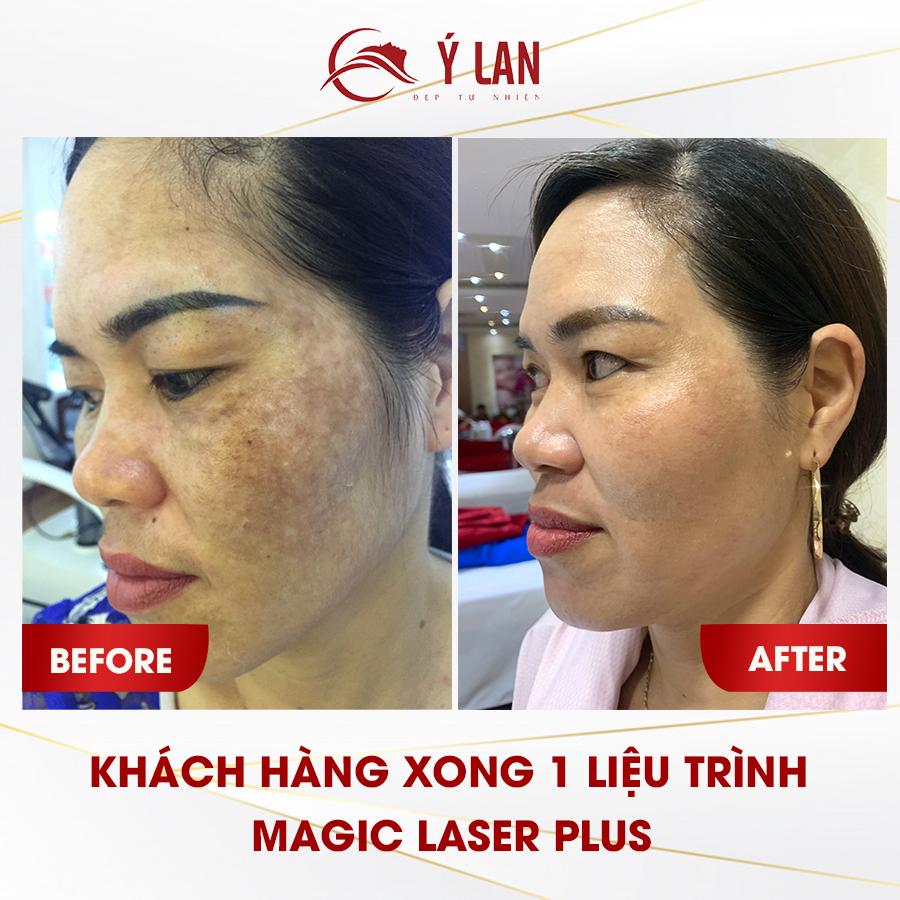 dấu hiệu của nám da mặt