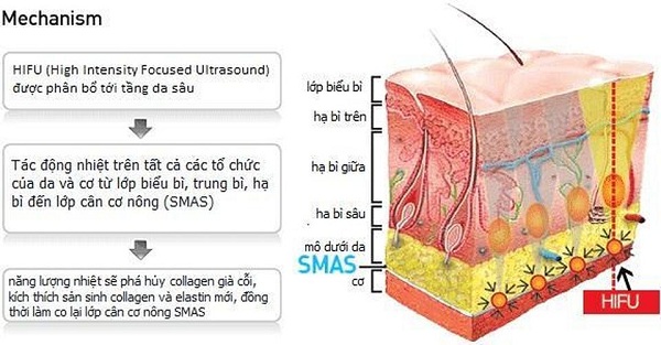 hình 3D tác động của HIFU Doublo