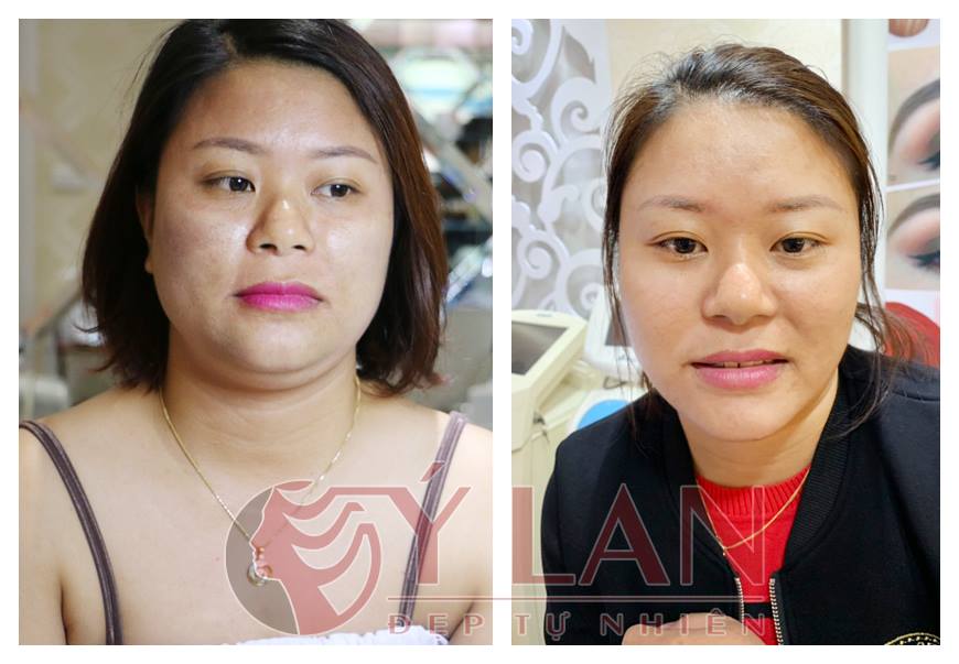 Kết quả nâng cơ xóa nọng cằm trẻ hóa da HIFU Doublo