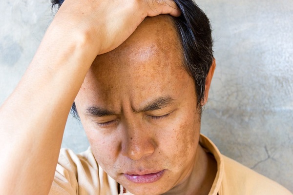 nguyen0-nhan-gay-nam-da-mat-nam-gioi