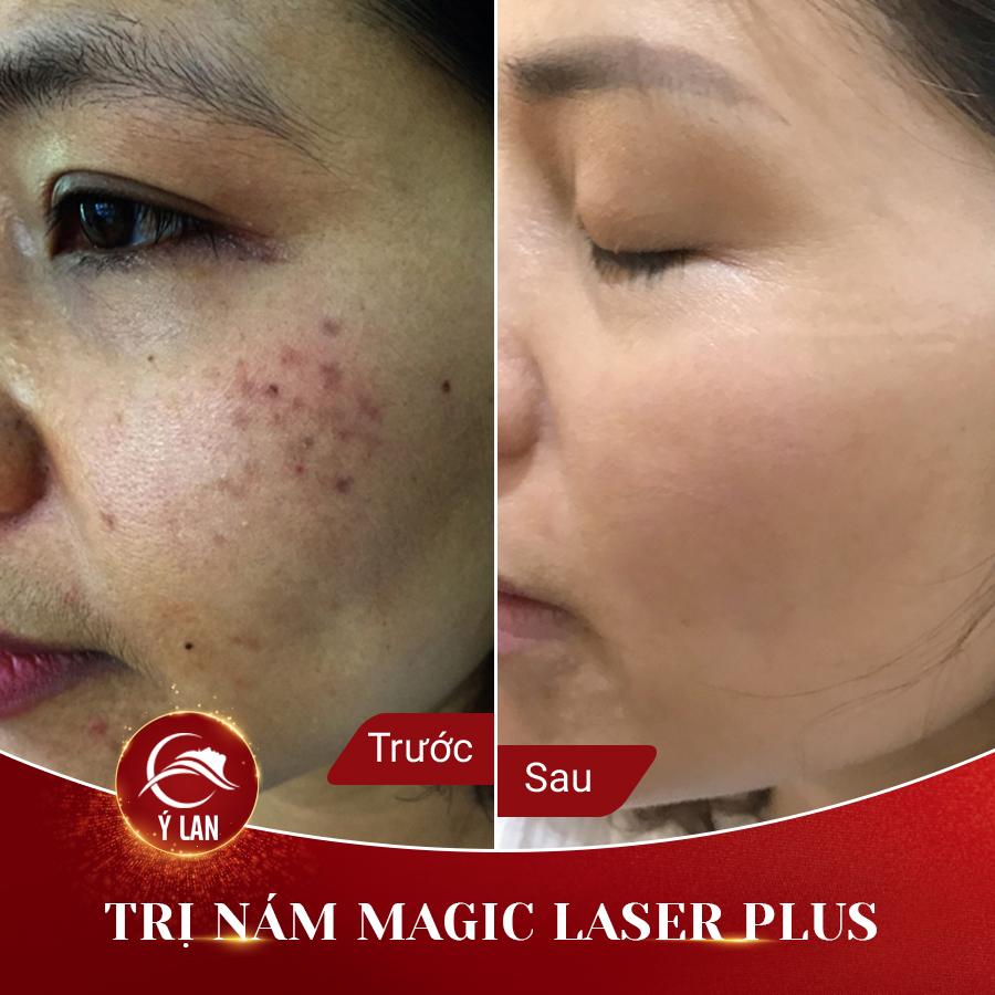 tri nam magic laser plus 2