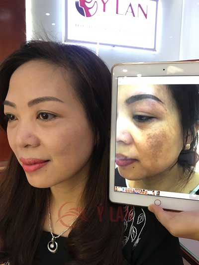 kết quả trị nám derma skin