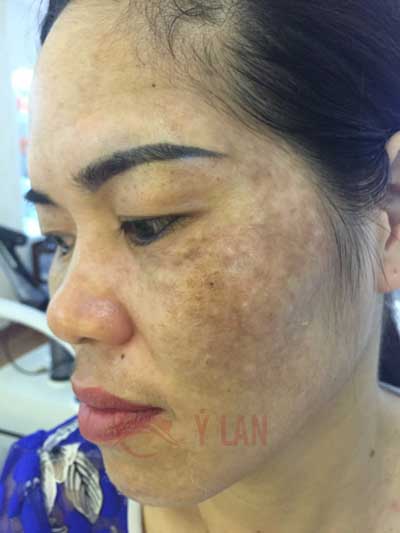 Trước khi trị nám tại thẩm mỹ viện Ý Lan