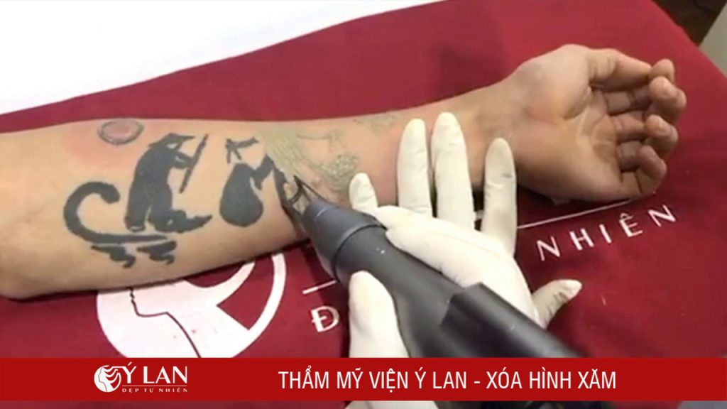 xoa-xam-may-an-toan-bang-laser