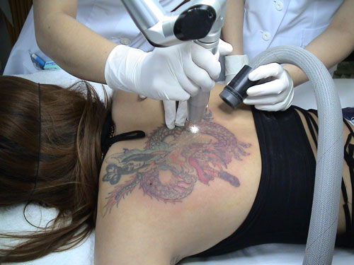 xoa-xam-may-an-toan-bang-laser-5